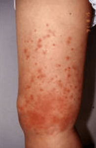 蜂窩織炎の症状の写真　発疹
